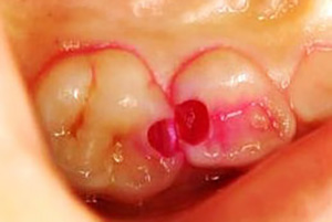 虫歯を染める「う蝕検知液」