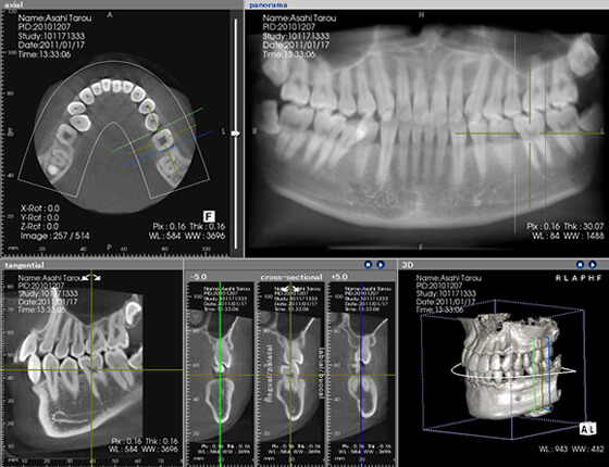 歯周病の進行度を把握する「CT検査」