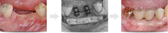 後退した歯茎を元に戻す「歯肉移植手術」